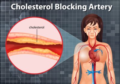 diagram showing cholesterol blocking artery human body